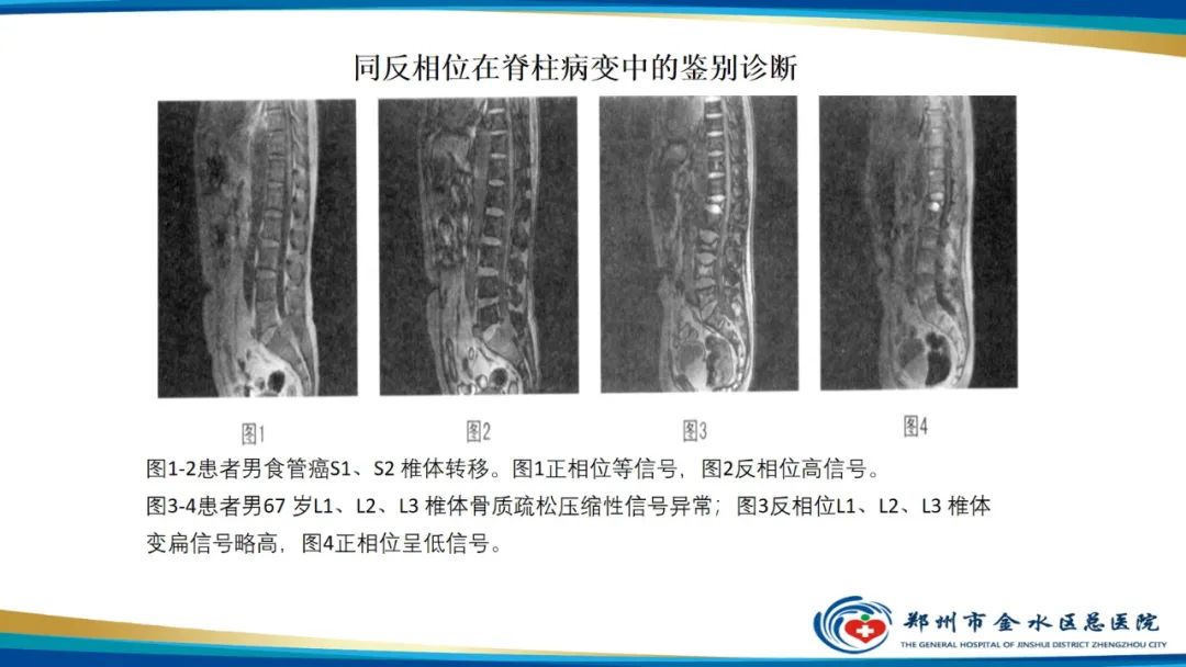 影像PPT - 【PPT】磁共振化学位移成像—水脂分离技术原理及应用浅述-30