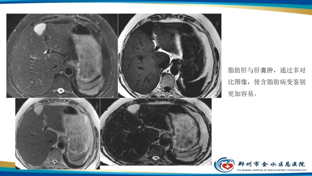 影像PPT - 【PPT】磁共振化学位移成像—水脂分离技术原理及应用浅述-28