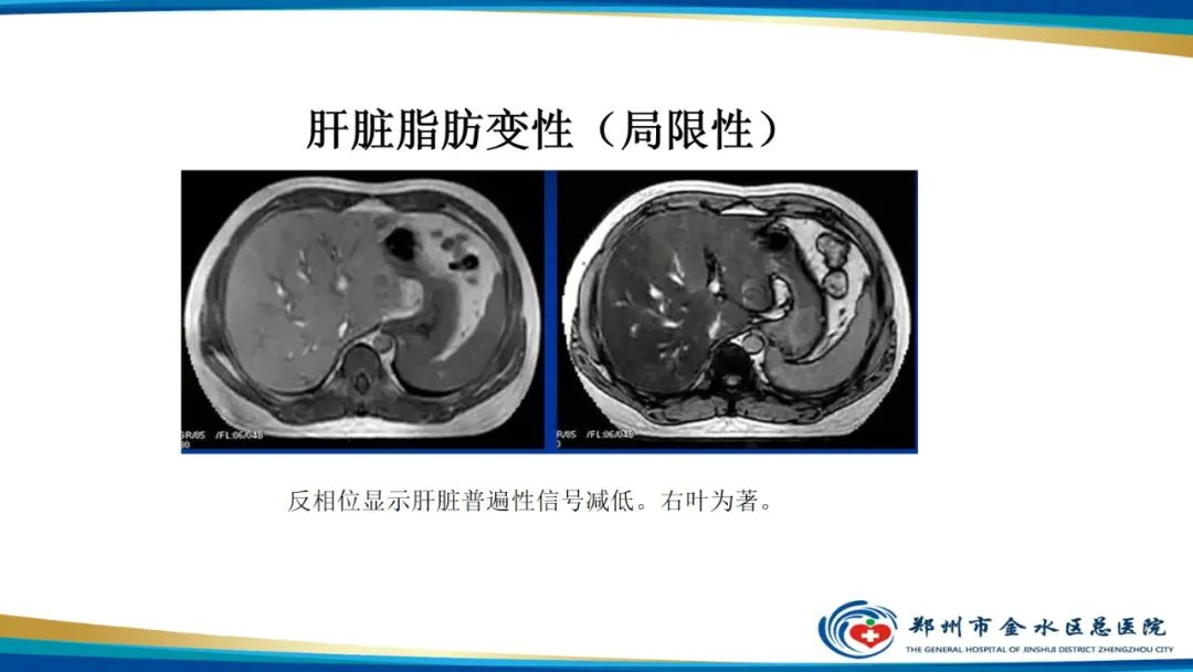 影像PPT - 【PPT】磁共振化学位移成像—水脂分离技术原理及应用浅述-27