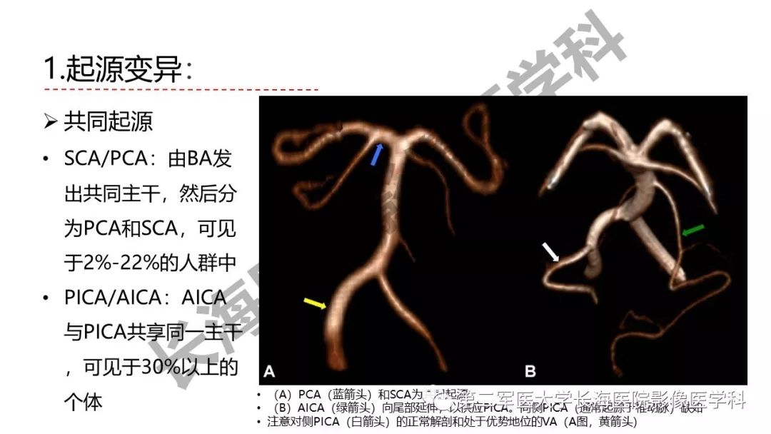 影像PPT - 【PPT】脑供血动脉常见变异-8