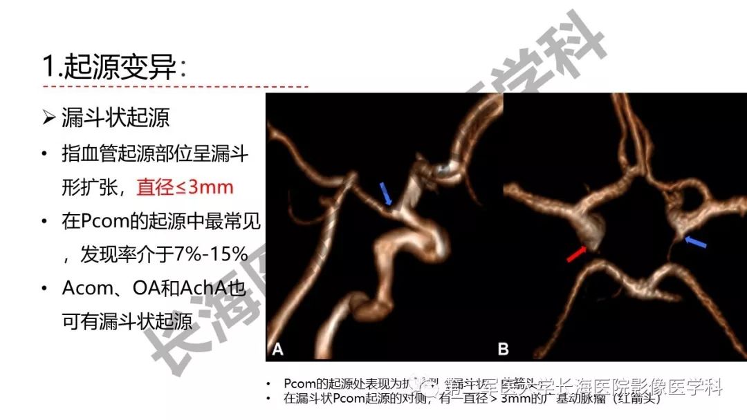 影像PPT - 【PPT】脑供血动脉常见变异-9