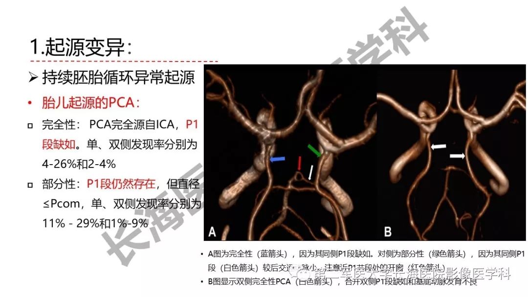 影像PPT - 【PPT】脑供血动脉常见变异-10