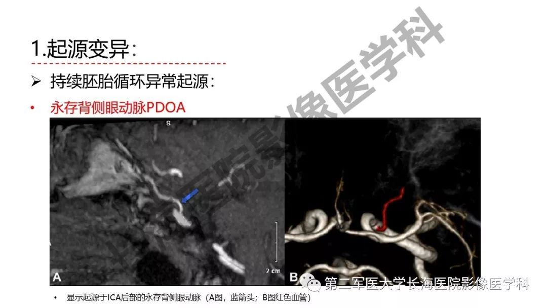 影像PPT - 【PPT】脑供血动脉常见变异-12