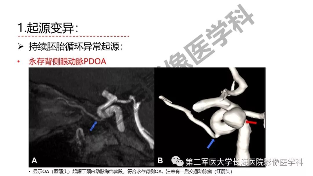 影像PPT - 【PPT】脑供血动脉常见变异-13