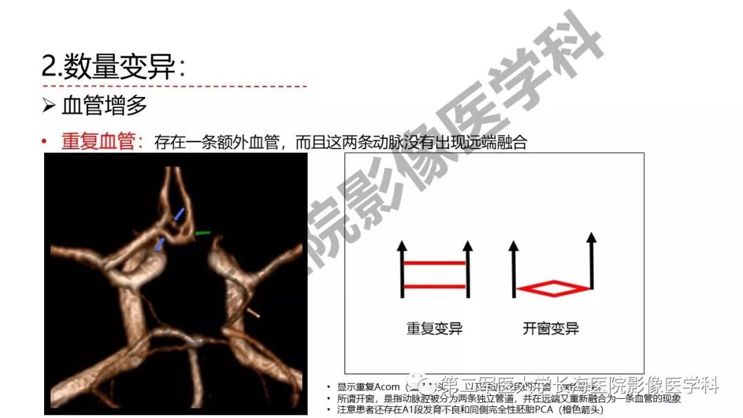 影像PPT - 【PPT】脑供血动脉常见变异-18