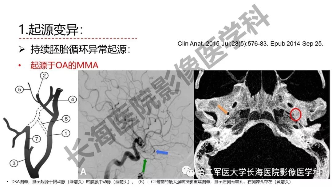 影像PPT - 【PPT】脑供血动脉常见变异-14