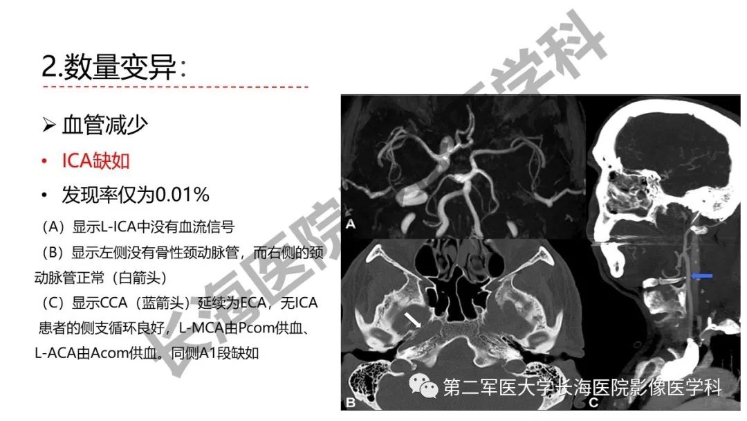 影像PPT - 【PPT】脑供血动脉常见变异-21