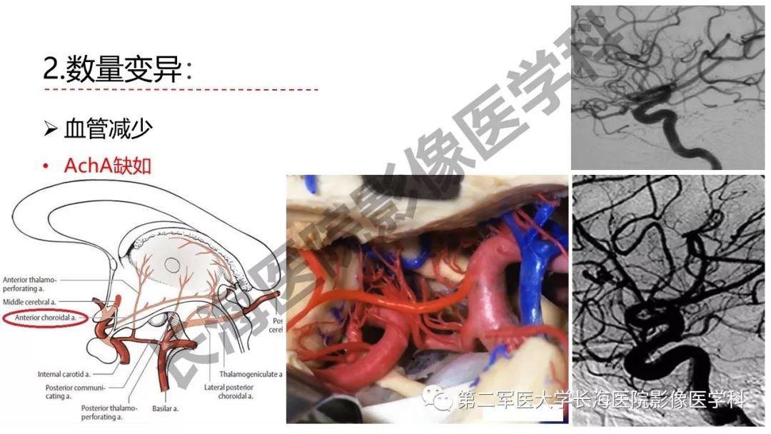 影像PPT - 【PPT】脑供血动脉常见变异-22