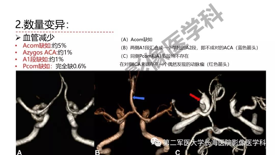 影像PPT - 【PPT】脑供血动脉常见变异-23