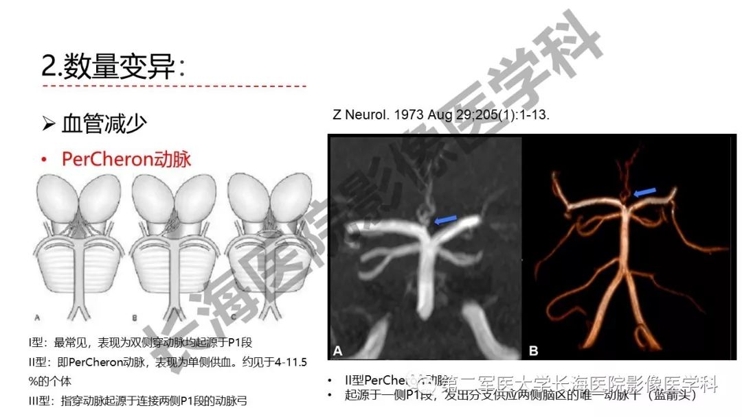 影像PPT - 【PPT】脑供血动脉常见变异-24
