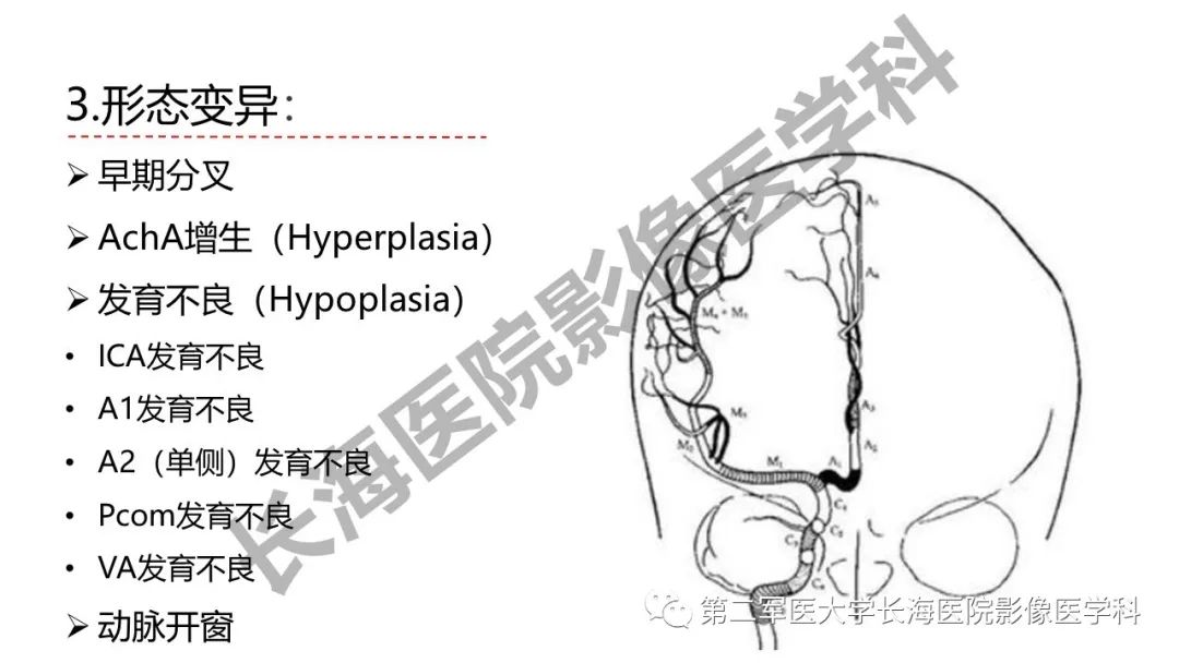 影像PPT - 【PPT】脑供血动脉常见变异-26