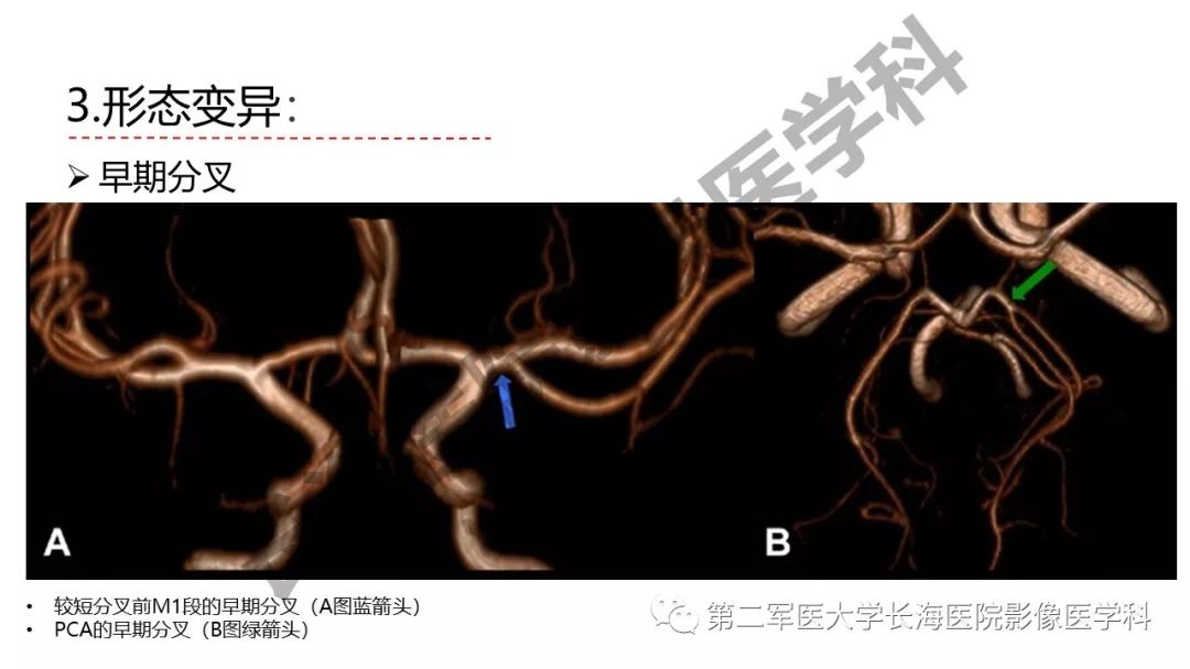 影像PPT - 【PPT】脑供血动脉常见变异-27