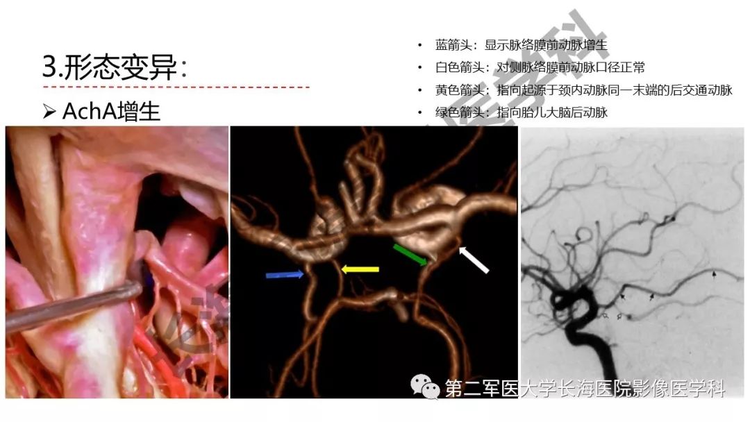影像PPT - 【PPT】脑供血动脉常见变异-28