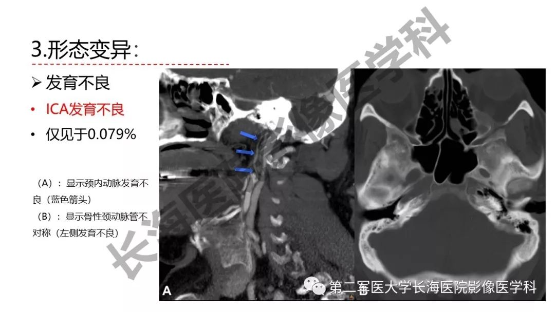影像PPT - 【PPT】脑供血动脉常见变异-29