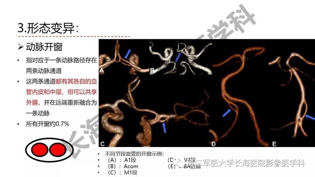 影像PPT - 【PPT】脑供血动脉常见变异-32