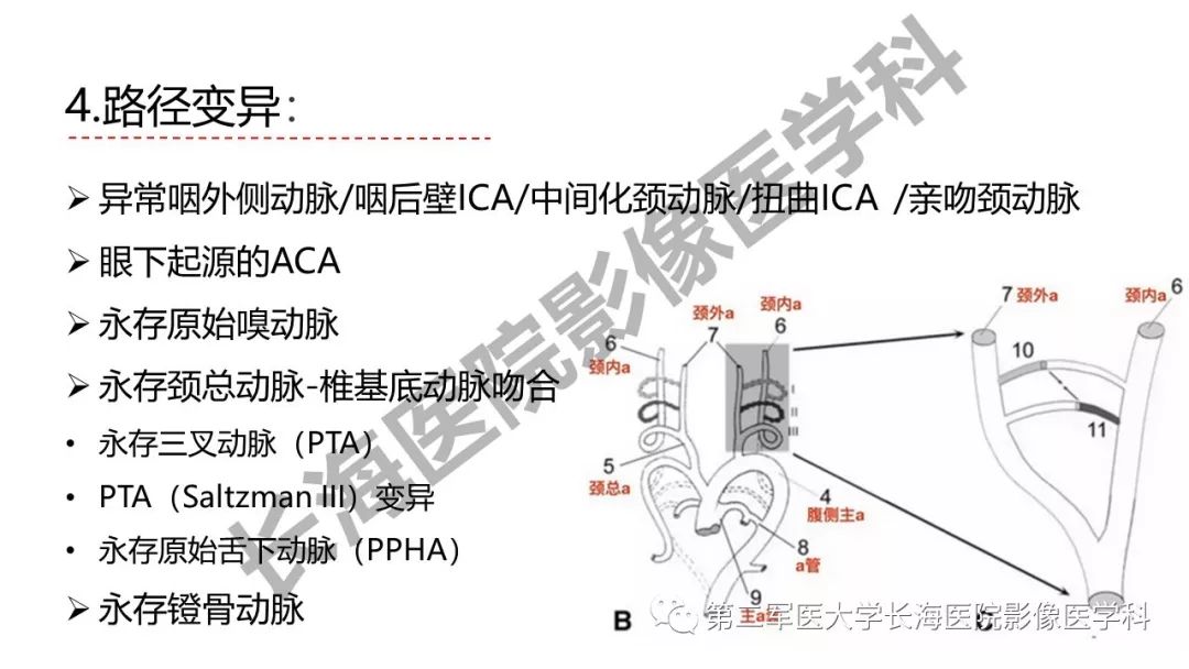 影像PPT - 【PPT】脑供血动脉常见变异-34