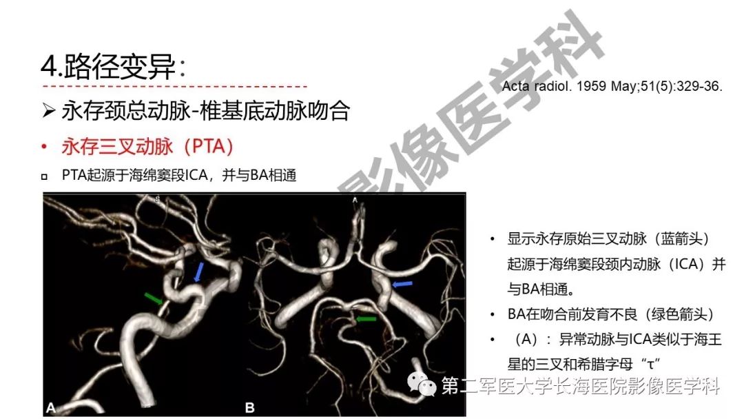 影像PPT - 【PPT】脑供血动脉常见变异-39