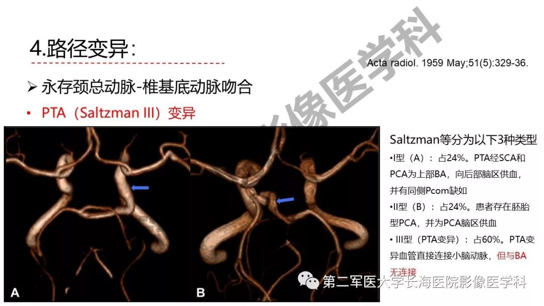 影像PPT - 【PPT】脑供血动脉常见变异-40