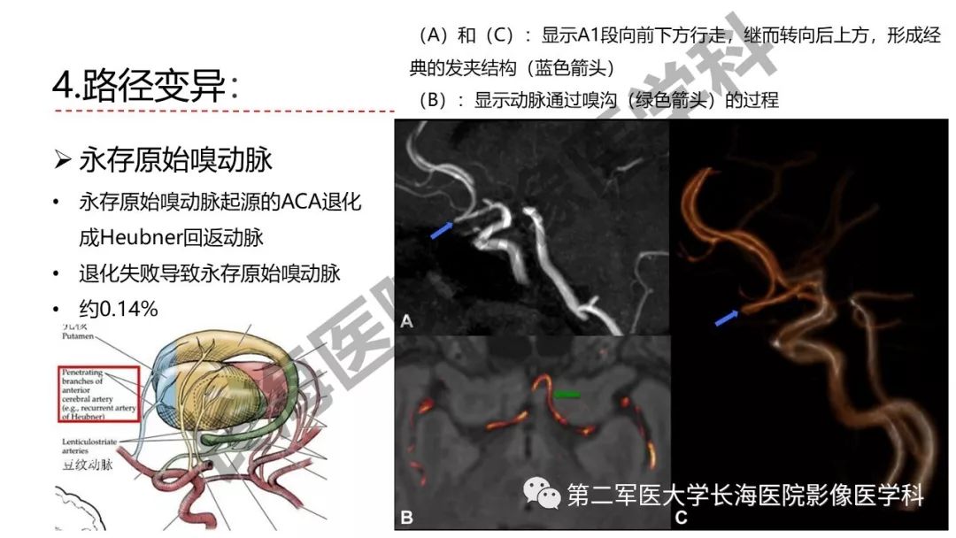影像PPT - 【PPT】脑供血动脉常见变异-37