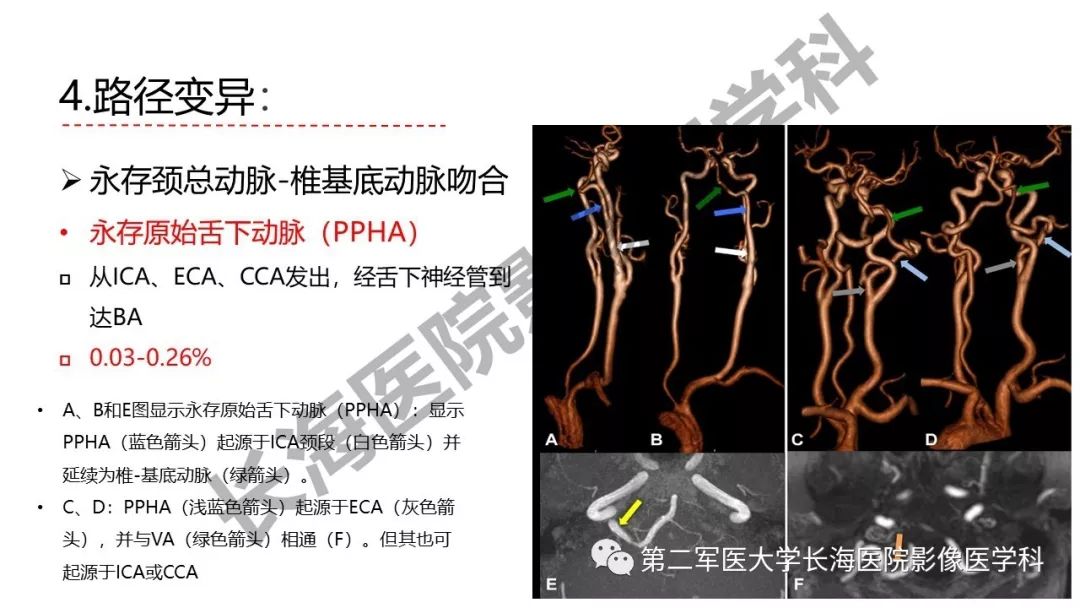 影像PPT - 【PPT】脑供血动脉常见变异-41