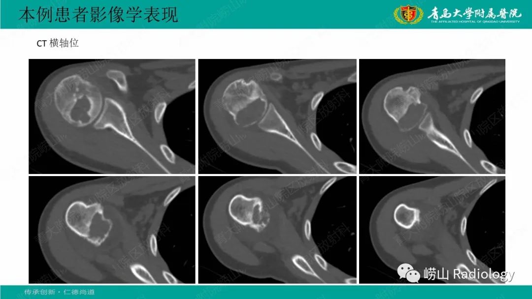 影像PPT - 【病例】肱骨干骺端软骨母细胞瘤1例CT及MR-4