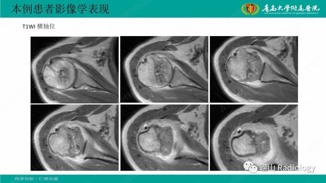 影像PPT - 【病例】肱骨干骺端软骨母细胞瘤1例CT及MR-7