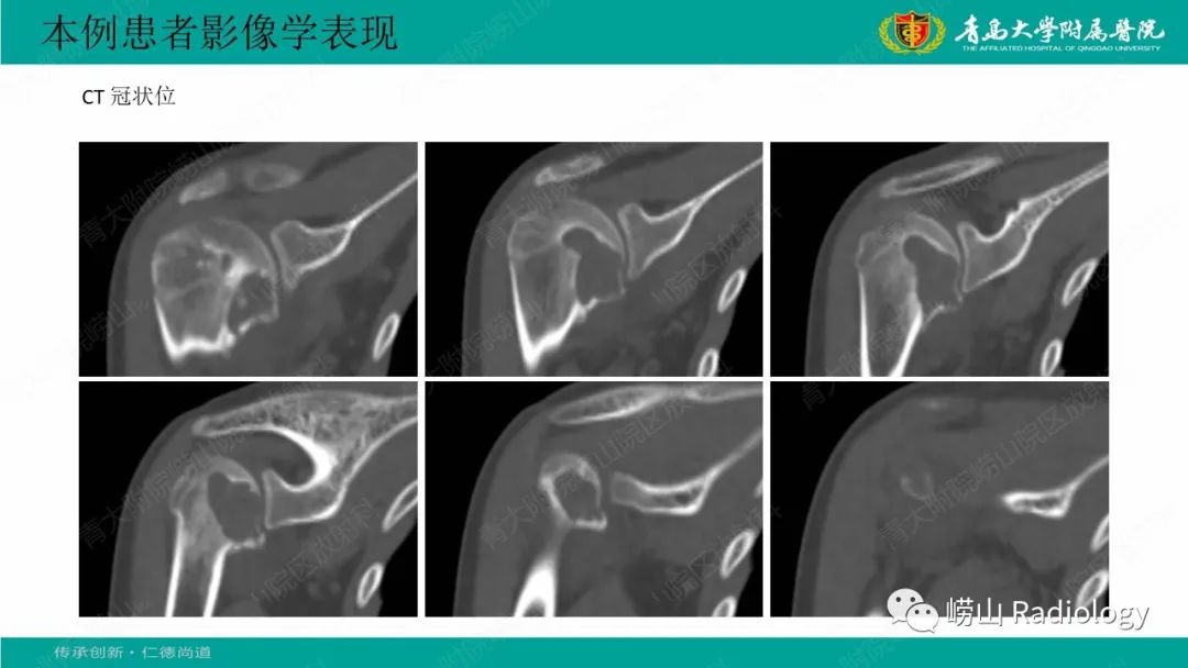 影像PPT - 【病例】肱骨干骺端软骨母细胞瘤1例CT及MR-5