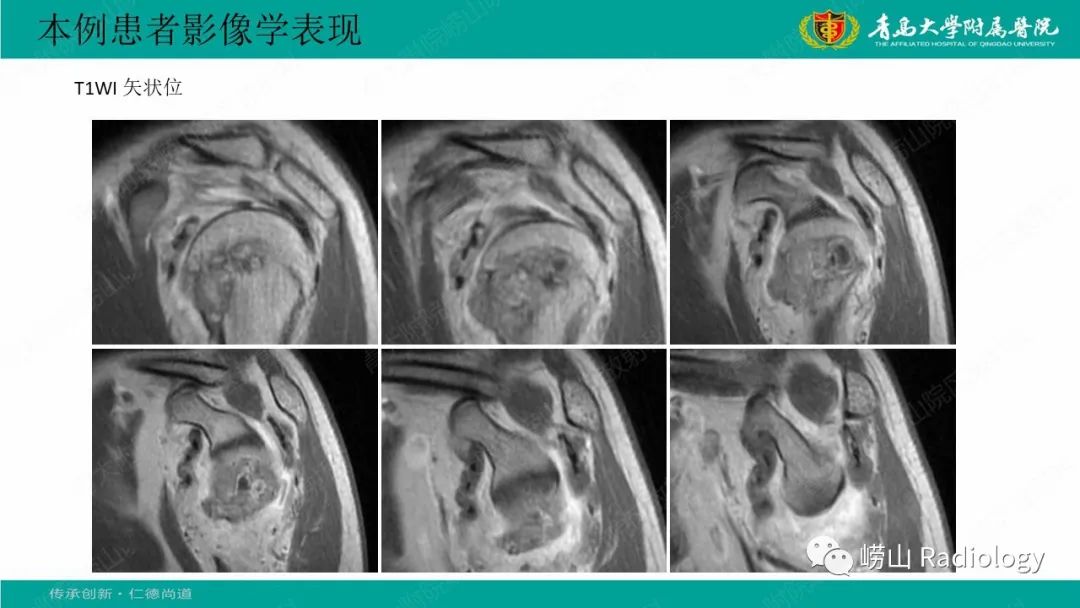 影像PPT - 【病例】肱骨干骺端软骨母细胞瘤1例CT及MR-8