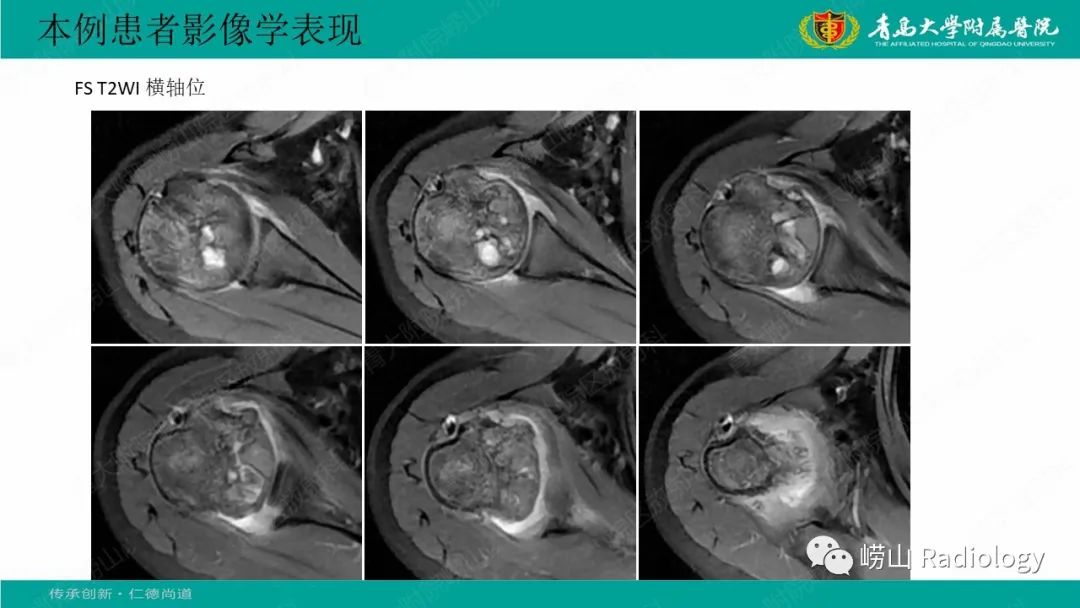 影像PPT - 【病例】肱骨干骺端软骨母细胞瘤1例CT及MR-9