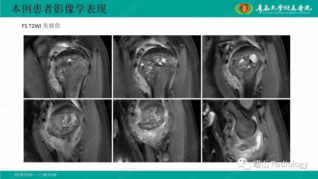 影像PPT - 【病例】肱骨干骺端软骨母细胞瘤1例CT及MR-10