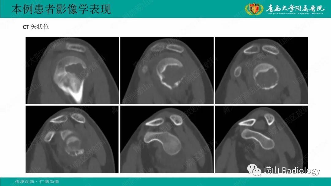 影像PPT - 【病例】肱骨干骺端软骨母细胞瘤1例CT及MR-6