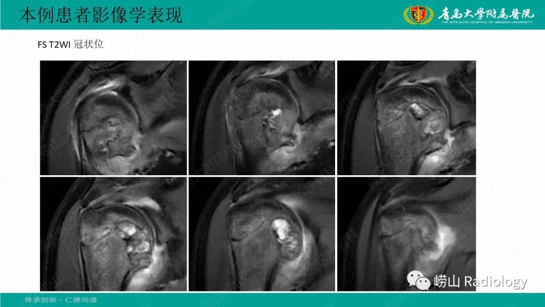 影像PPT - 【病例】肱骨干骺端软骨母细胞瘤1例CT及MR-11