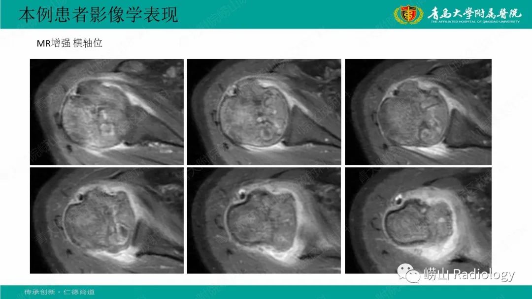 影像PPT - 【病例】肱骨干骺端软骨母细胞瘤1例CT及MR-12