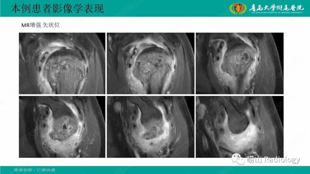 影像PPT - 【病例】肱骨干骺端软骨母细胞瘤1例CT及MR-13