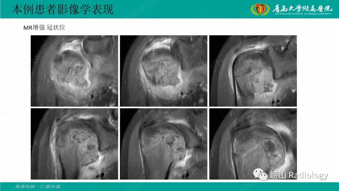 影像PPT - 【病例】肱骨干骺端软骨母细胞瘤1例CT及MR-14