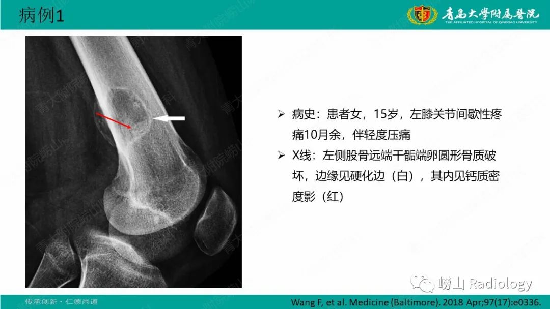 影像PPT - 【病例】肱骨干骺端软骨母细胞瘤1例CT及MR-20