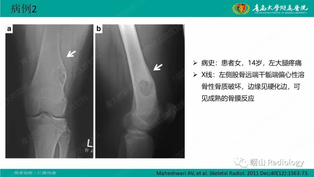 影像PPT - 【病例】肱骨干骺端软骨母细胞瘤1例CT及MR-23
