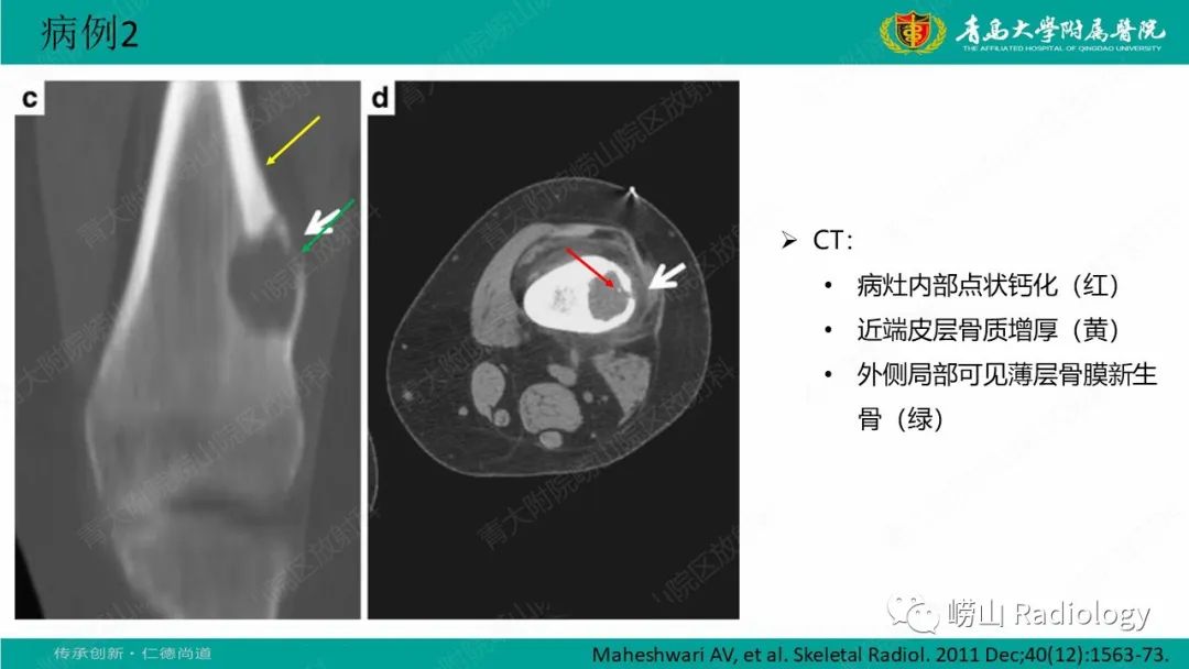 影像PPT - 【病例】肱骨干骺端软骨母细胞瘤1例CT及MR-24