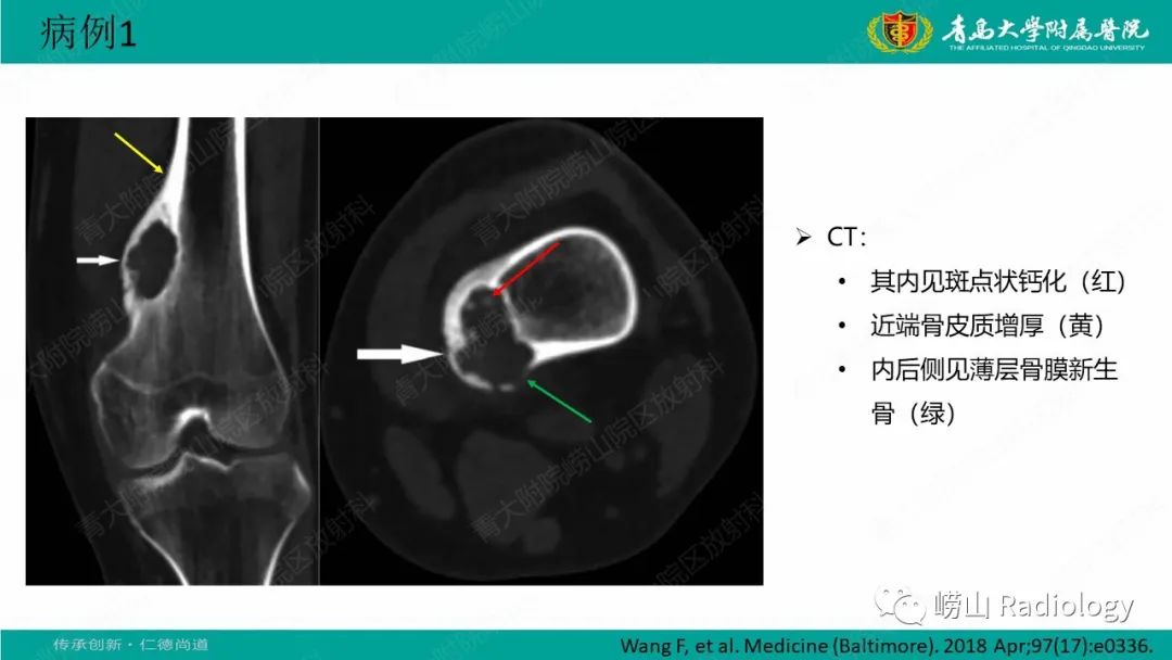 影像PPT - 【病例】肱骨干骺端软骨母细胞瘤1例CT及MR-21