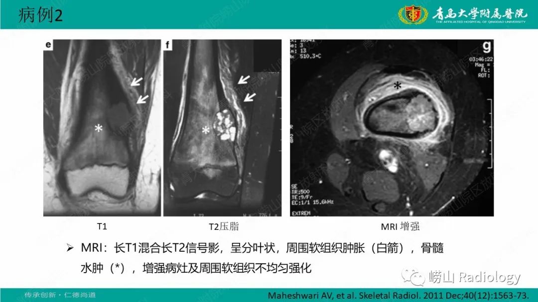 影像PPT - 【病例】肱骨干骺端软骨母细胞瘤1例CT及MR-25