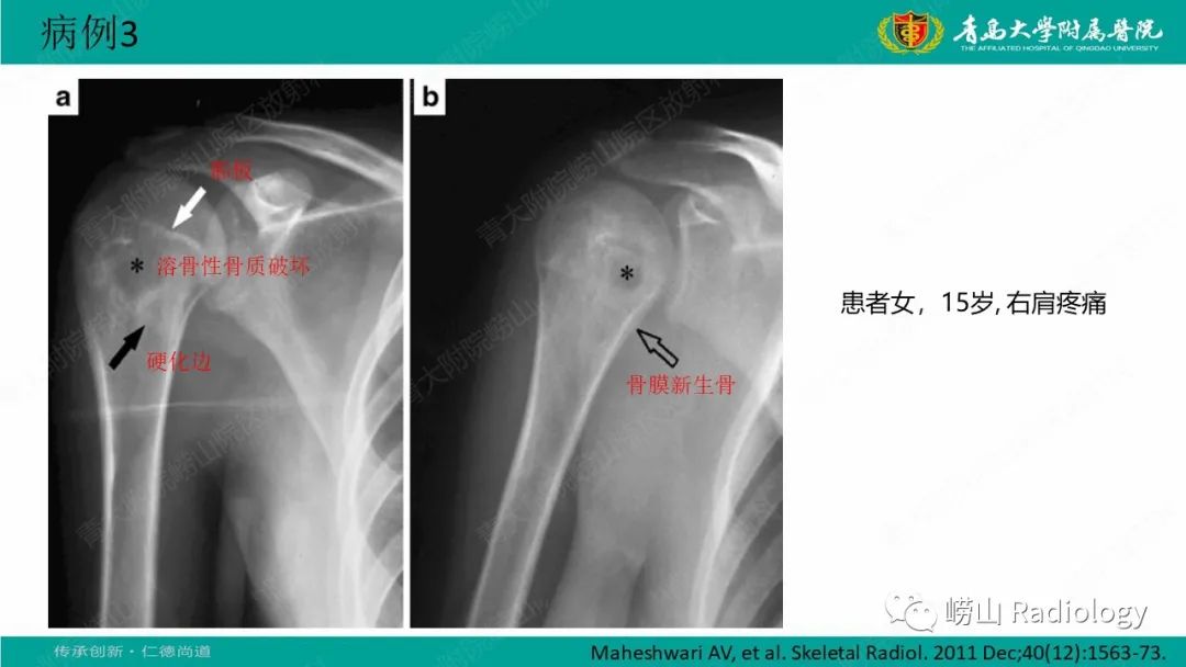 影像PPT - 【病例】肱骨干骺端软骨母细胞瘤1例CT及MR-26