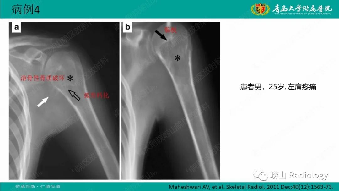 影像PPT - 【病例】肱骨干骺端软骨母细胞瘤1例CT及MR-27