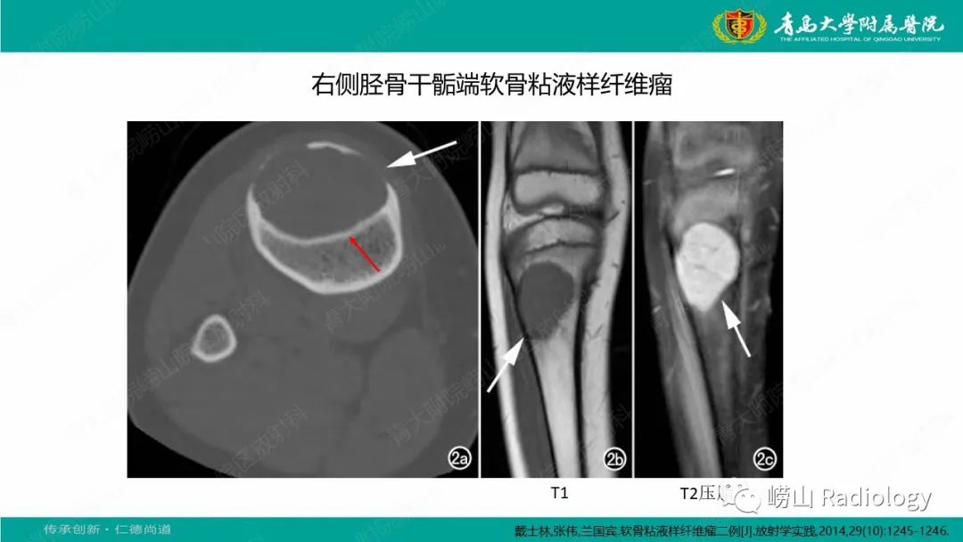 影像PPT - 【病例】肱骨干骺端软骨母细胞瘤1例CT及MR-31