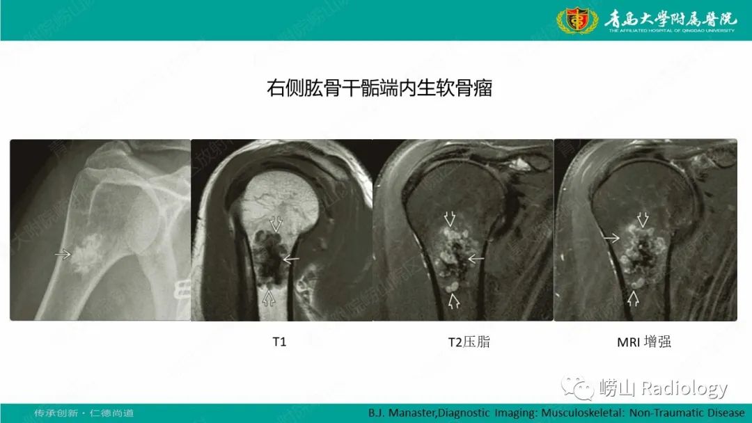 影像PPT - 【病例】肱骨干骺端软骨母细胞瘤1例CT及MR-33
