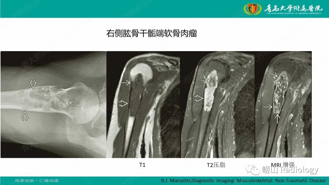 影像PPT - 【病例】肱骨干骺端软骨母细胞瘤1例CT及MR-35