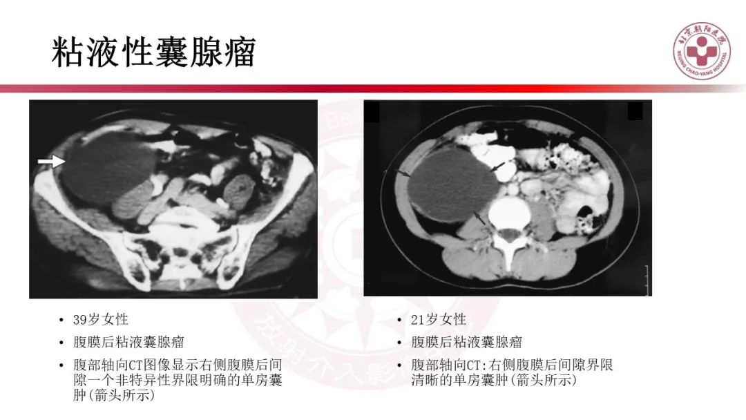 影像PPT - 【PPT】腹膜后囊性肿物-28