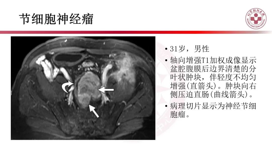影像PPT - 【PPT】腹膜后囊性肿物-34