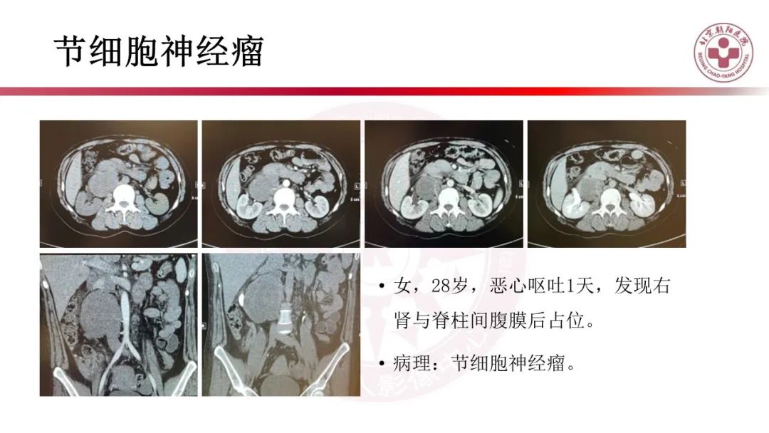 影像PPT - 【PPT】腹膜后囊性肿物-35