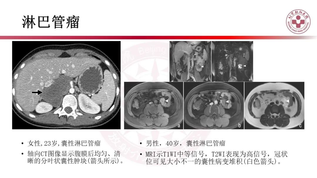 影像PPT - 【PPT】腹膜后囊性肿物-31