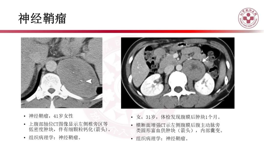 影像PPT - 【PPT】腹膜后囊性肿物-38